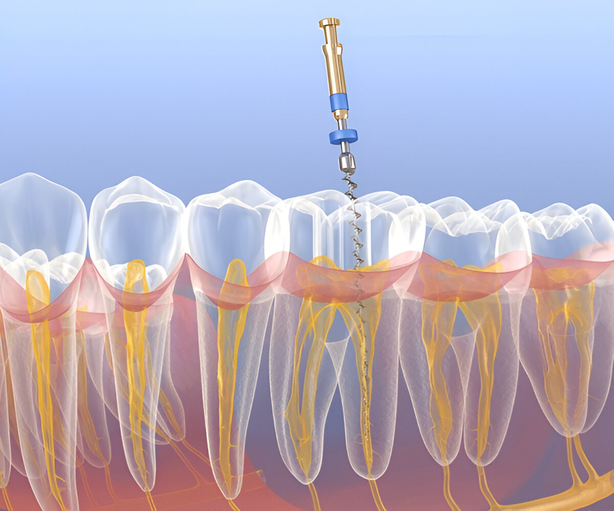 Root Canal Treatment